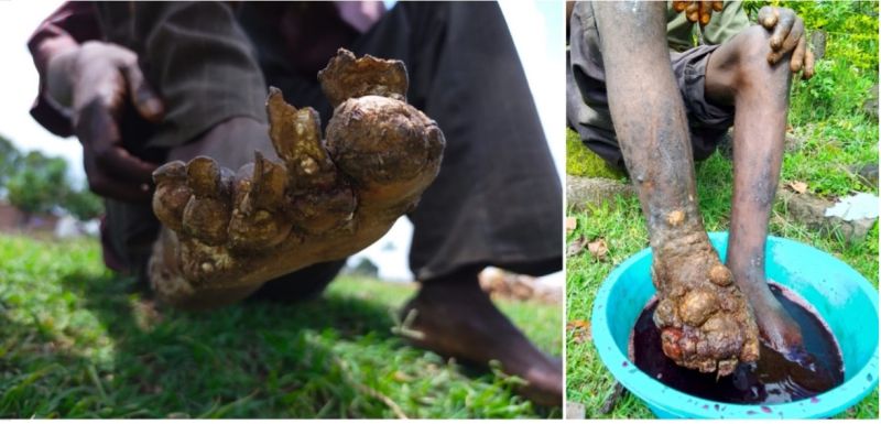 Tungiasis examples of infection